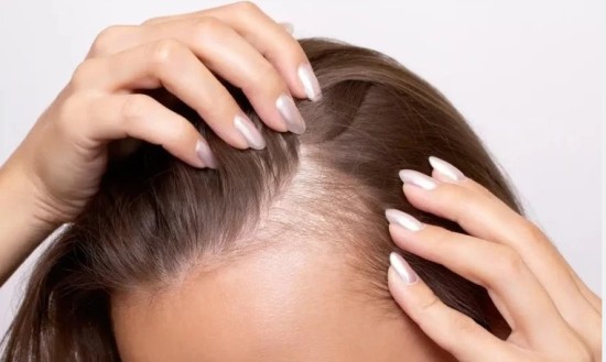 تساقط الشعر عند النساء.....