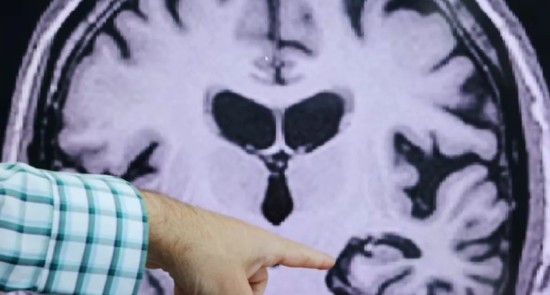 دراسة: التغيرات الدماغية...