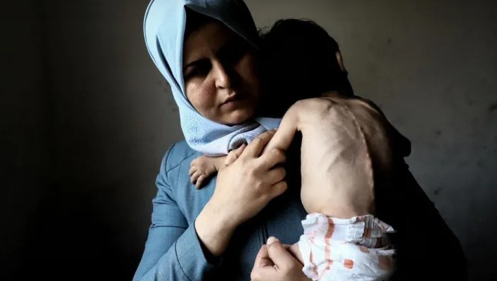 الصحة العالمية: وثقنا 32 وفاة بغزة نتيجة سوء التغذية
