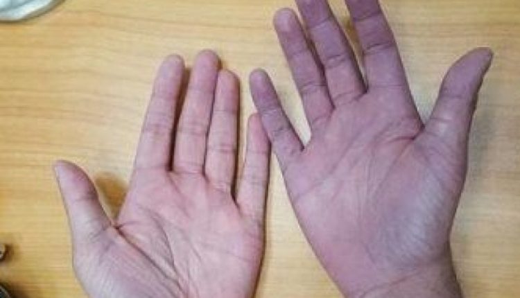 تعرف على الأسباب التي تجعل جلدك يتحول إلى اللون الأزرق

