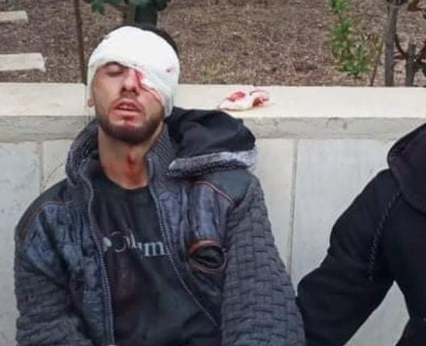 شهيد وعدة إصابات خلال اقتحام الاحتلال مدينة نابلس

