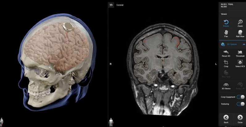 إيلون ماسك يعلن عن نجاح زرع شريحة دماغية في أول إنسان
