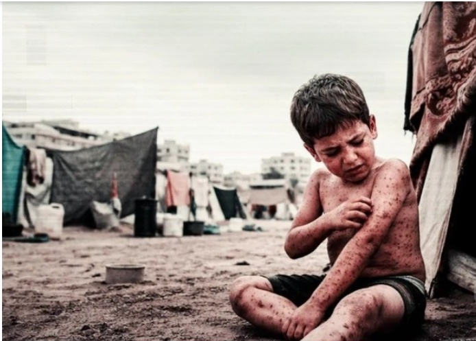 الأونروا تحذر من تفاقم الأمراض الجلدية في غزة

