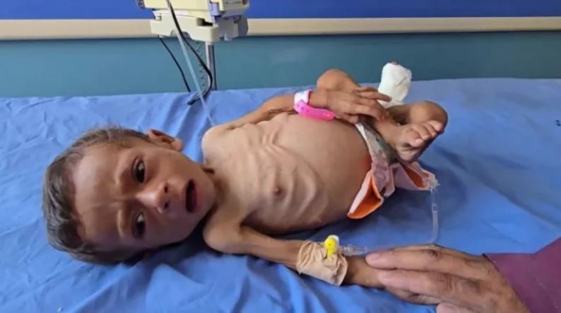 5 وفيات نتيجة المجاعة وسوء التغذية خلال الـ24 ساعة الماضية

