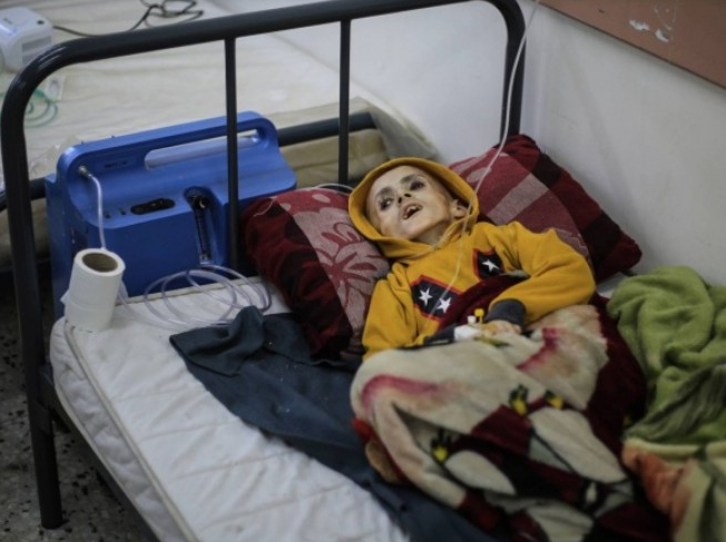 غزة: 112 طفلا يدخلون المستشفيات يوميا بسبب سوء التغذية

