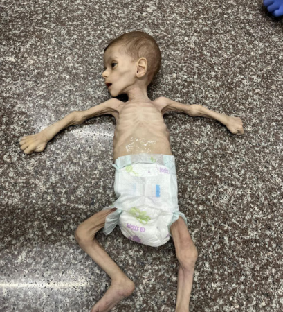 وفاة طفلين شمال وجنوب قطاع غزة بسبب سوء التغذية والمجاعة
