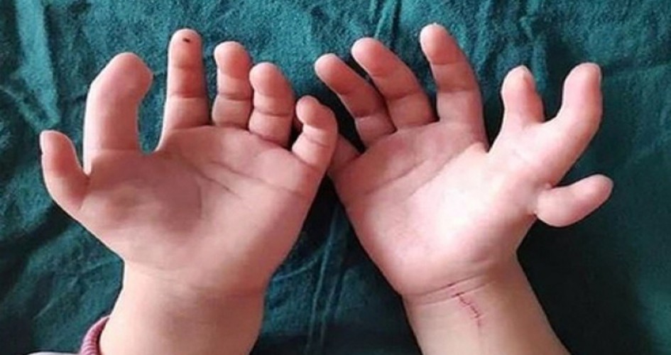 طفلة بـ 14 إصبعا
