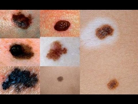 كيف نميز الشامة العادية عن الخبيثة؟