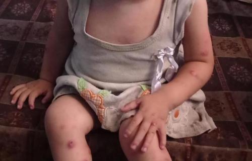 خيام النازحين في غزة تتحول إلى بؤر عدوى