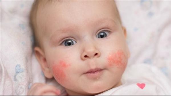 حساسية الطعام لدى الأطفال.. كيف يكتشفها الأهل ويتعاملون معها؟