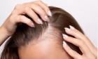 تساقط الشعر عند النساء.....